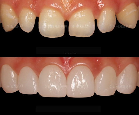 how to fix front teeth gap without braces