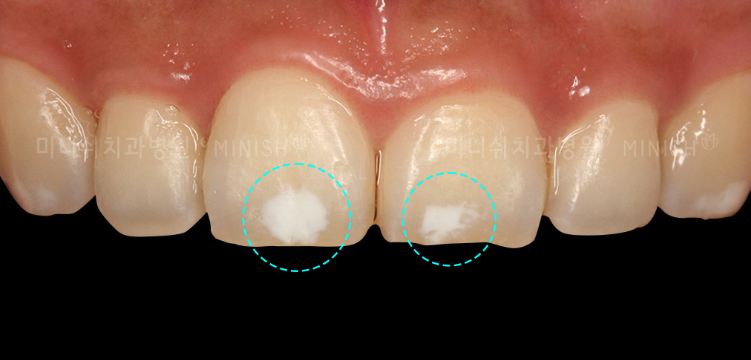 What Are the White Spots On My Teeth?