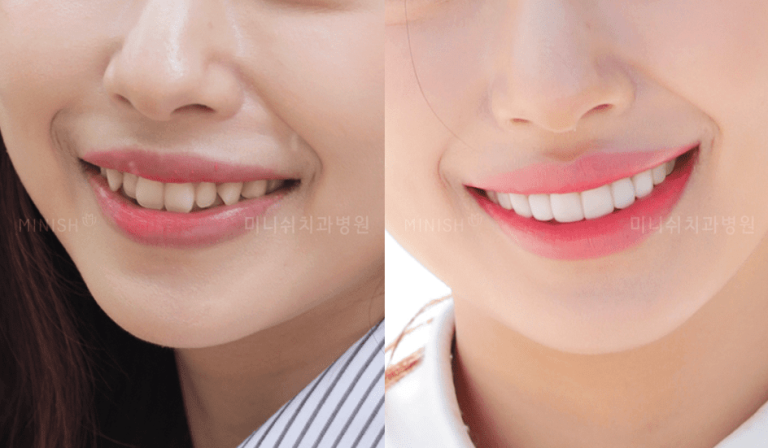 Veneers Before and After