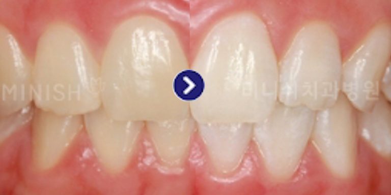 Teeth Whitening Before and After